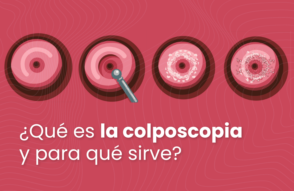 ¿Qué es la colposcopia y para qué sirve?